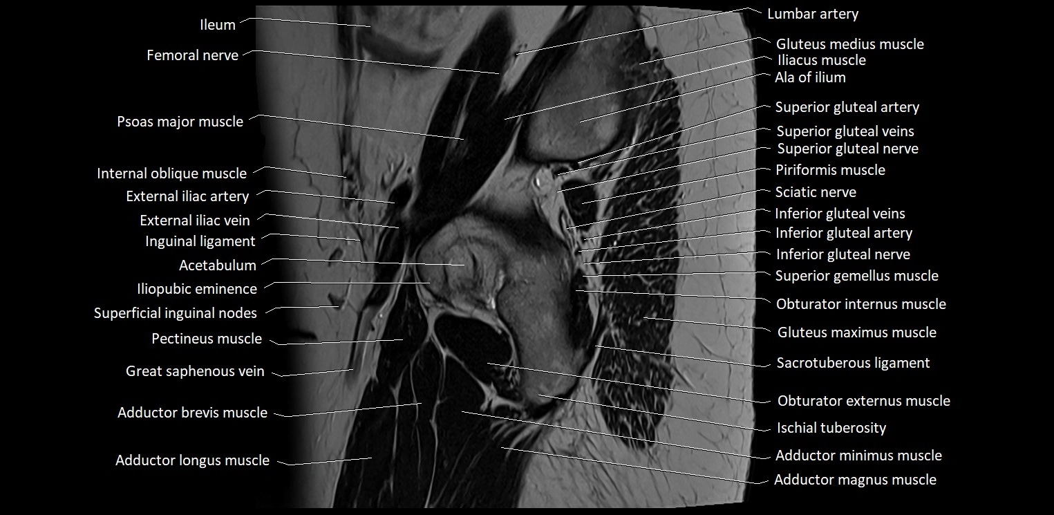 Sagittal cross sectional anatomy of female pelvis (MRI 3T) image 3.webp